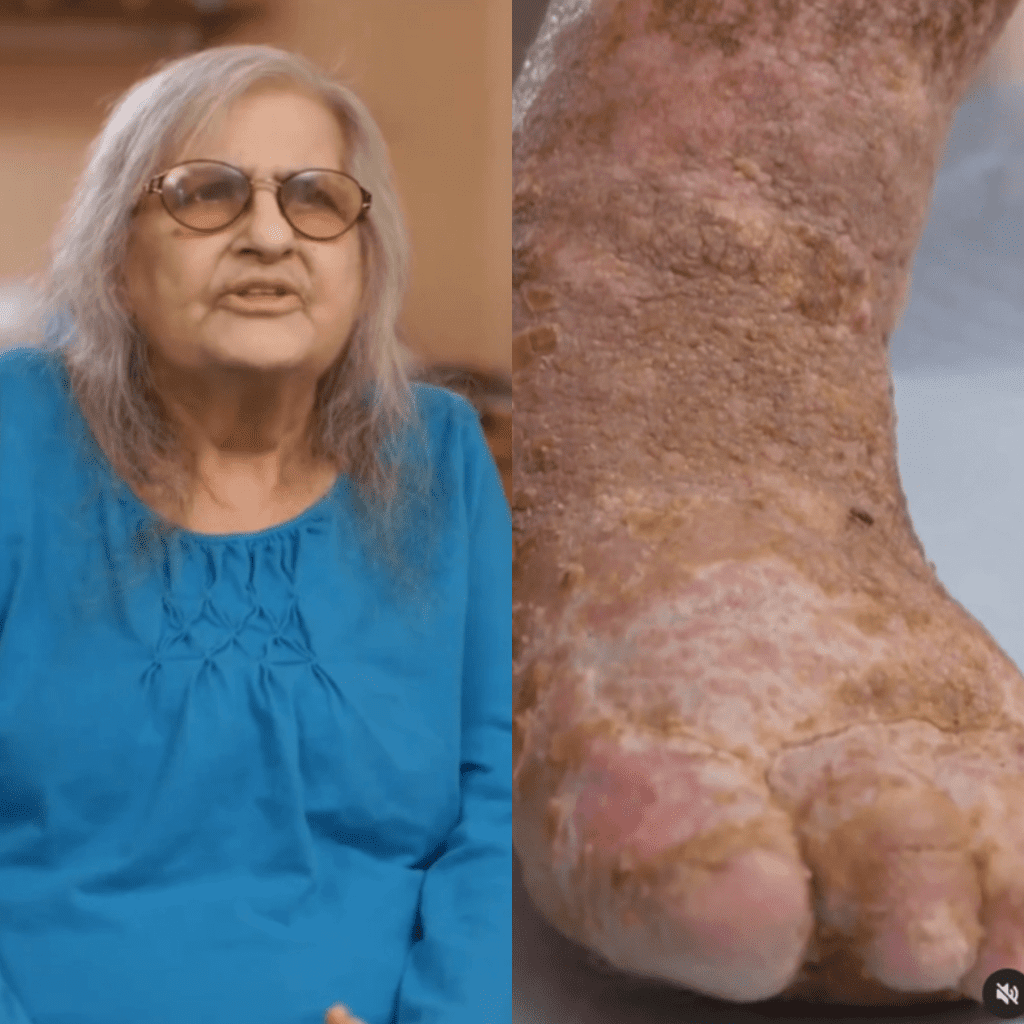 woman with maggots in between her toes