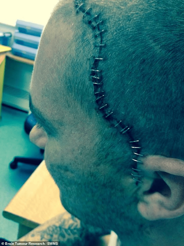 Man Diagnosed with Brain Tumour