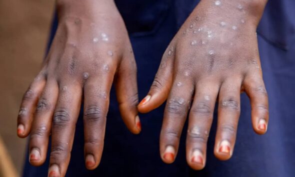 Mpox Outbreak