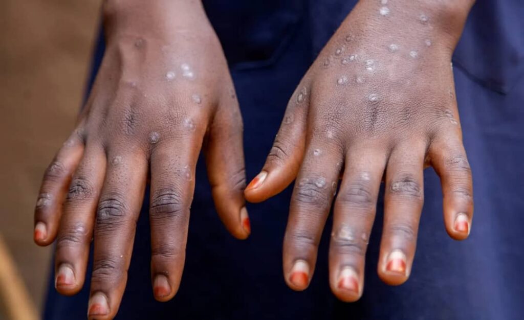 Mpox Outbreak